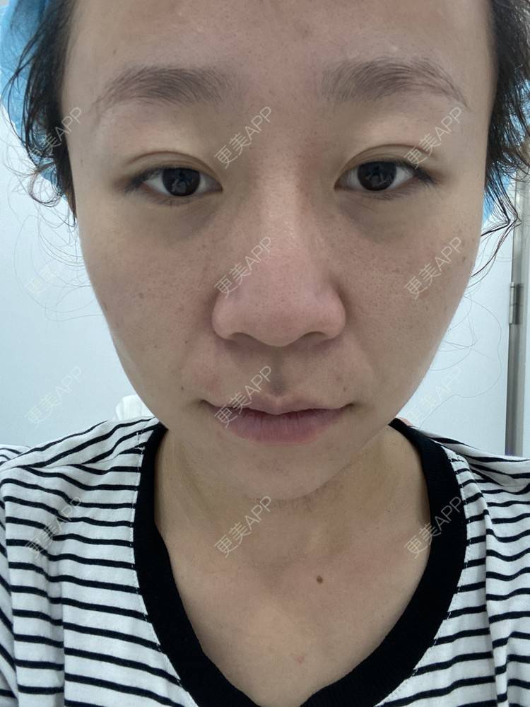 更美 - YXP💋的玻尿酸鼻部经验 | 玻尿酸鼻部 | 上海