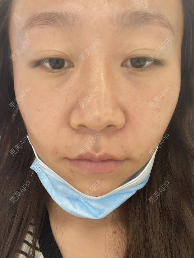 更美 - YXP💋的玻尿酸鼻部经验 | 玻尿酸鼻部 | 上海