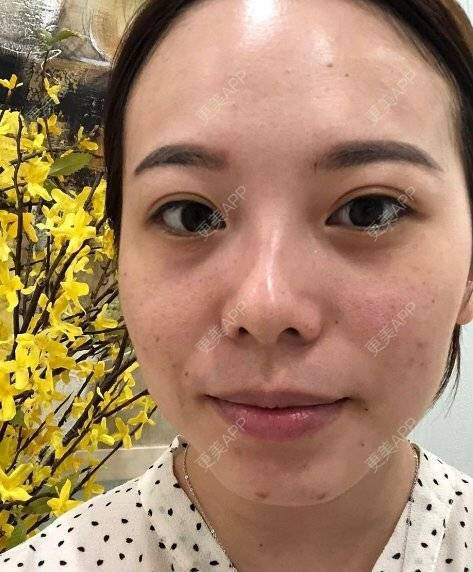 更美 - 更美用户Zyu0LttufV的祛眼袋经验 | 祛眼袋 | 激光去眼袋 | 祛黑眼圈 | 激光淡化黑眼圈 | 综合去眼袋 | 武汉