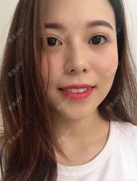 更美 - 更美用户Zyu0LttufV的祛眼袋经验 | 祛眼袋 | 激光去眼袋 | 祛黑眼圈 | 激光淡化黑眼圈 | 综合去眼袋 | 武汉
