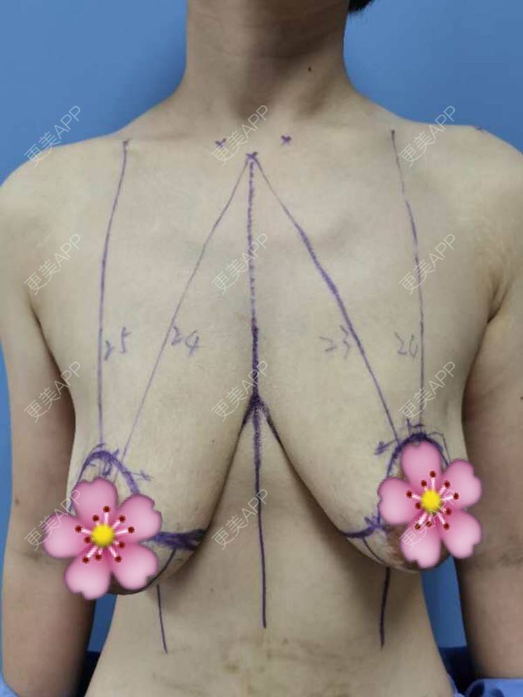 更美 - 更美用户ZN5LsrY6bk的乳晕缩小经验 | 乳晕缩小 | 缩胸手术 | 胸部下垂矫正 | 杭州
