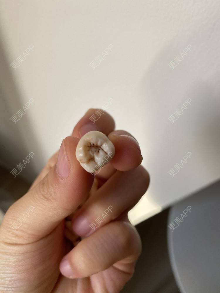 更美 - 更美用户uhGw5rpdBc的拔智齿经验 | 拔智齿