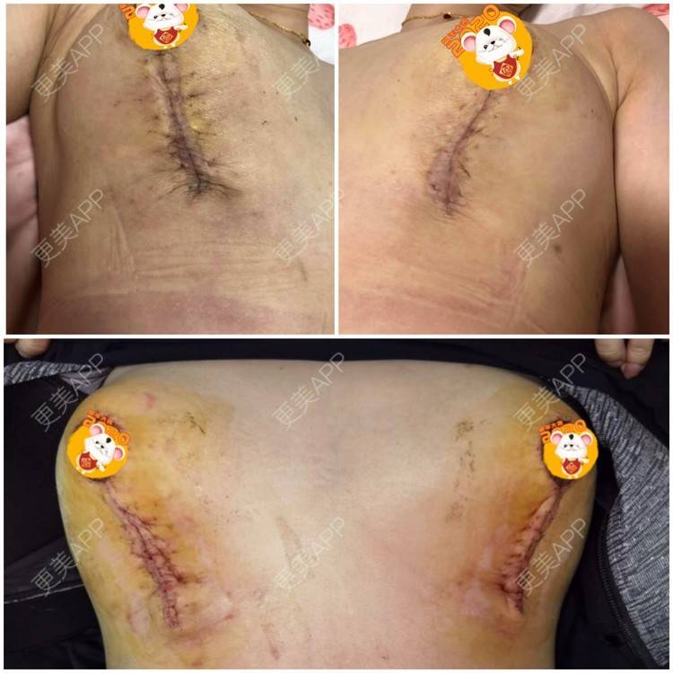 更美 - 更美用户ZN5LsrY6bk的乳晕缩小经验 | 乳晕缩小 | 缩胸手术 | 胸部下垂矫正 | 杭州