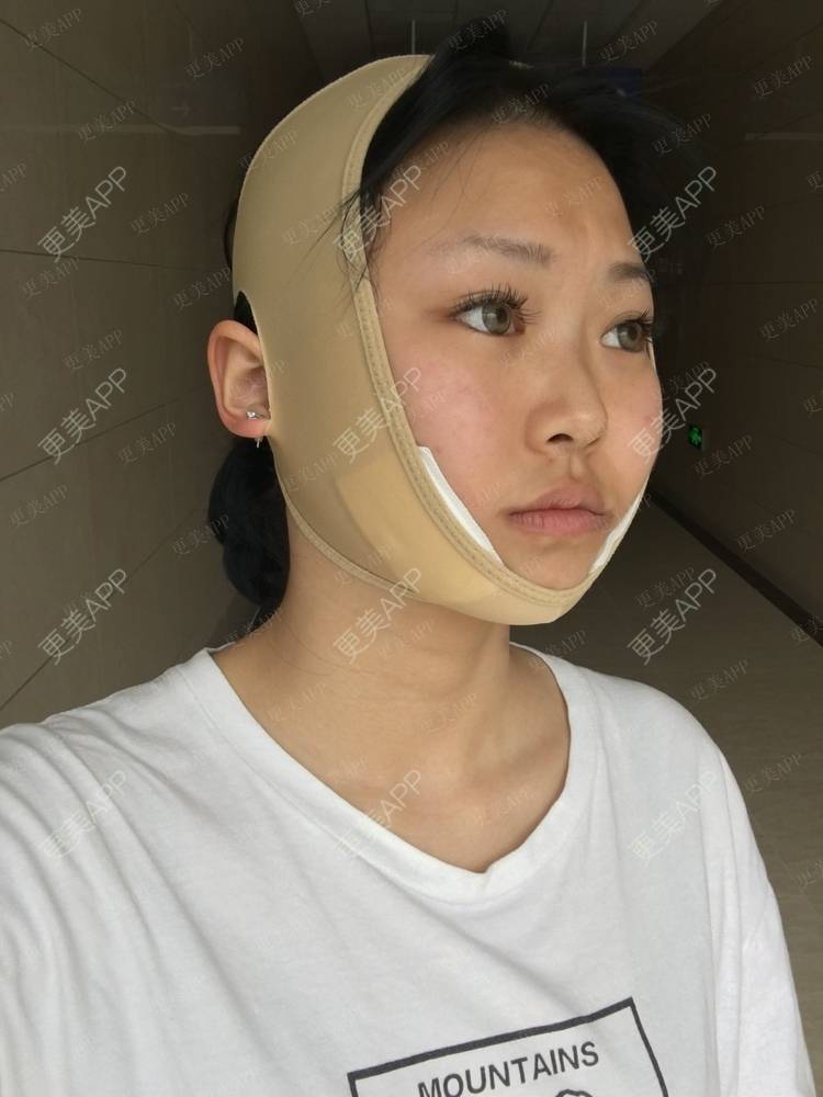 更美 - ⌒★感情上的伤偻.的颧骨内推经验 | 颧骨内推 | 成都 | 轮廓修复术 | 颧弓降低 | 下颌角切除 | 颧骨颧弓整形