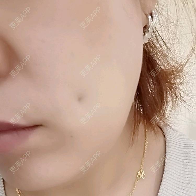 更美 - 更美用户LGbmfI8BBY的除皱瘦脸经验 | 除皱瘦脸 | 重庆