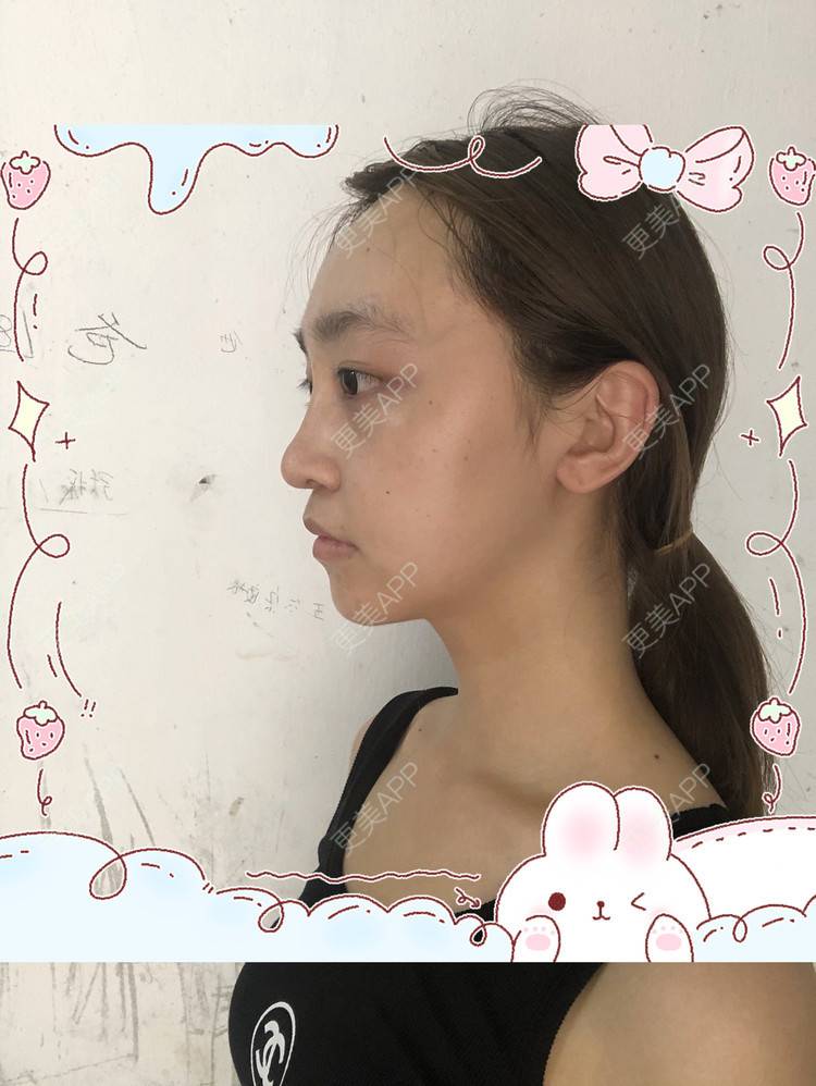 更美 - 更美用户Vb1ObdFyMB的自体脂肪隆鼻经验 | 自体脂肪隆鼻 | 无锡