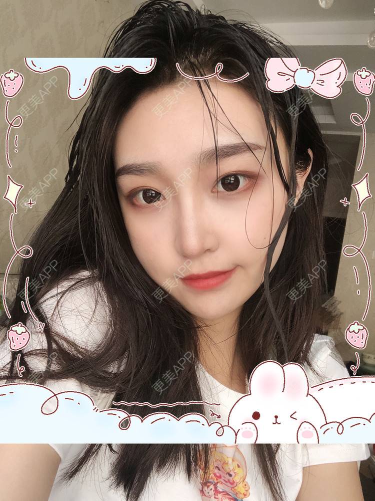 更美 - 更美用户Vb1ObdFyMB的自体脂肪隆鼻经验 | 自体脂肪隆鼻 | 无锡