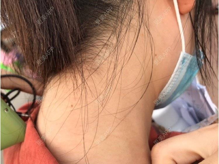 更美 - 原原原原原来是你的光子嫩肤经验 | 光子嫩肤 | 上海
