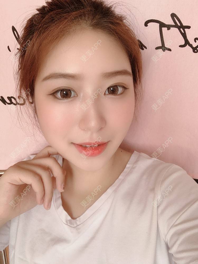 更美 - 更美用户7pTvKPec6Q的吸脂瘦脸经验 | 双下巴吸脂 | 吸脂瘦脸