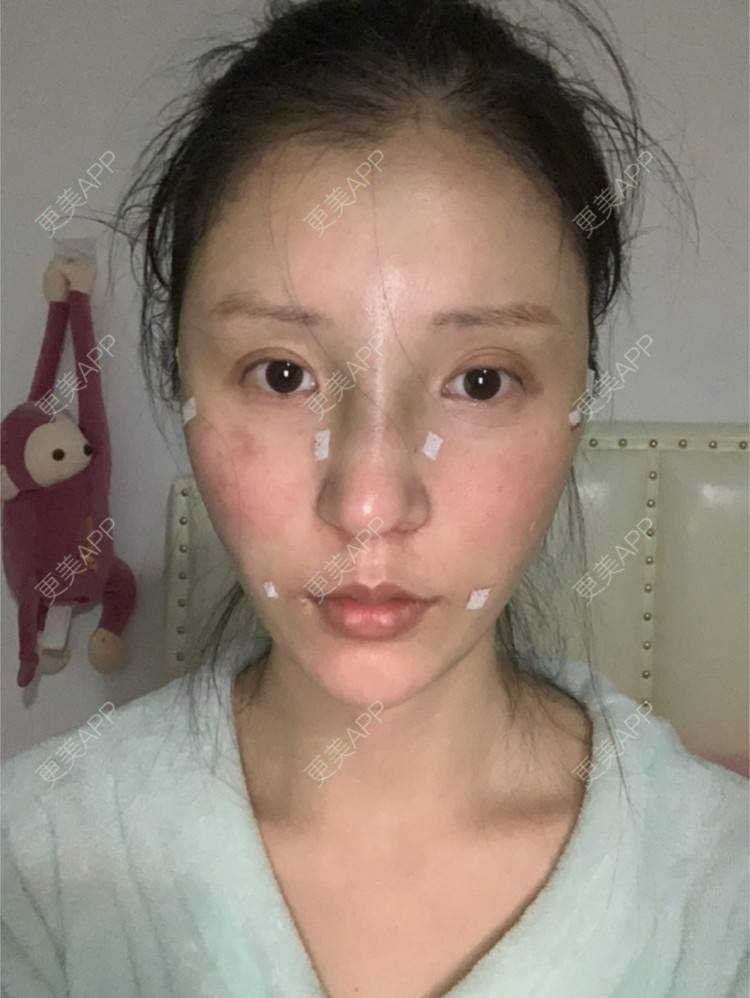 更美 - 更美用户8XxYZCQA5R的埋线提升经验 | 南京 | 埋线提升