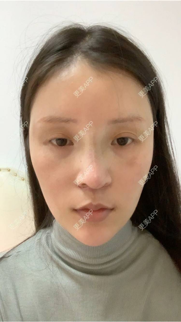 更美 - 更美用户8XxYZCQA5R的埋线提升经验 | 南京 | 埋线提升