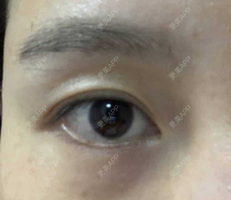 更美 - GeeHyun智贤的提眉修复经验 | 提眉修复 | 重庆