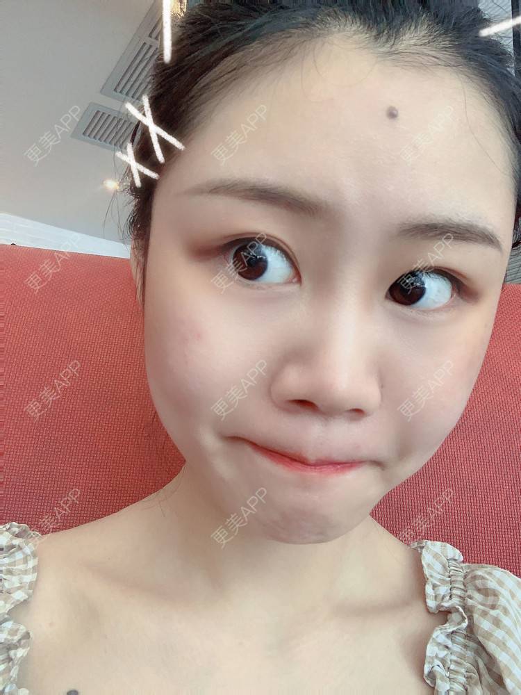 更美 - 喵咩咩胀的胶原蛋白丰面颊经验 | 北京 | 胶原蛋白丰面颊