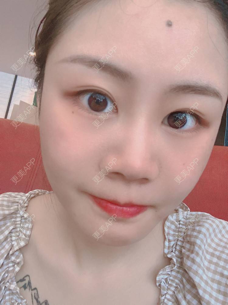 更美 - 喵咩咩胀的胶原蛋白丰面颊经验 | 北京 | 胶原蛋白丰面颊