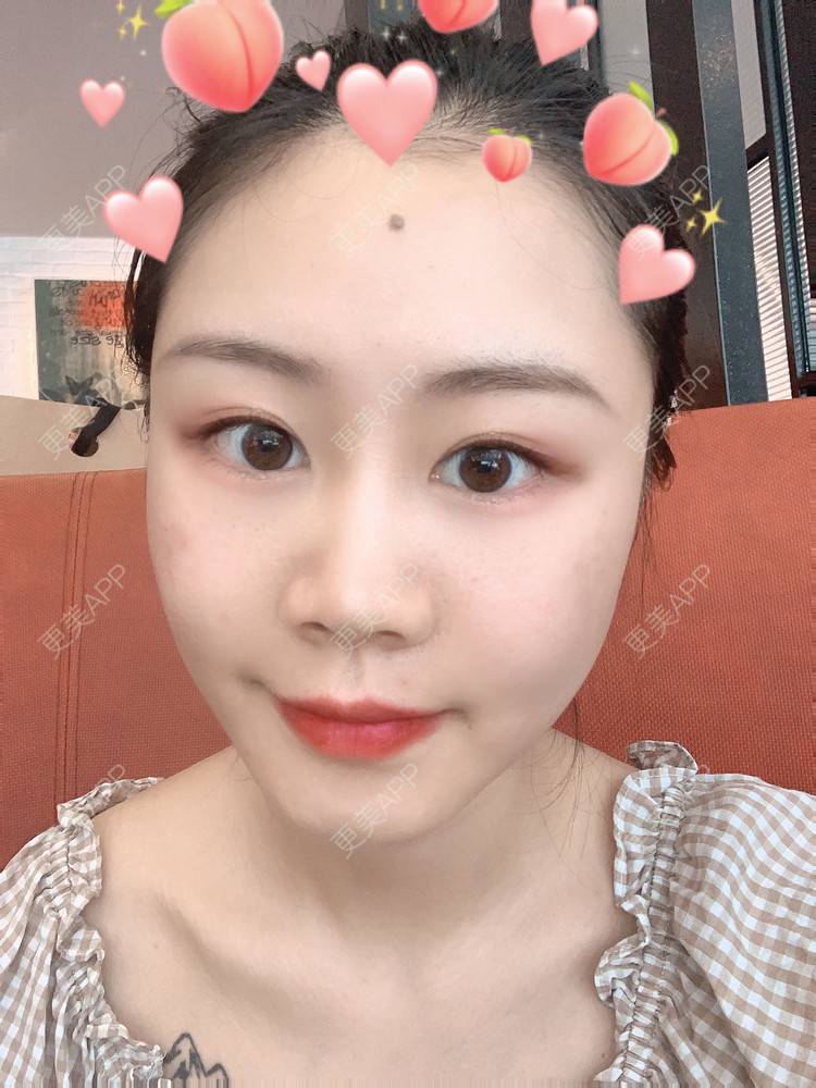 更美 - 喵咩咩胀的胶原蛋白丰面颊经验 | 北京 | 胶原蛋白丰面颊