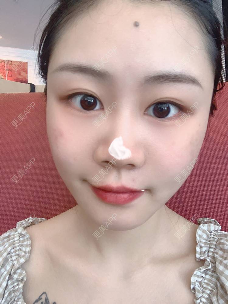 更美 - 喵咩咩胀的胶原蛋白丰面颊经验 | 北京 | 胶原蛋白丰面颊