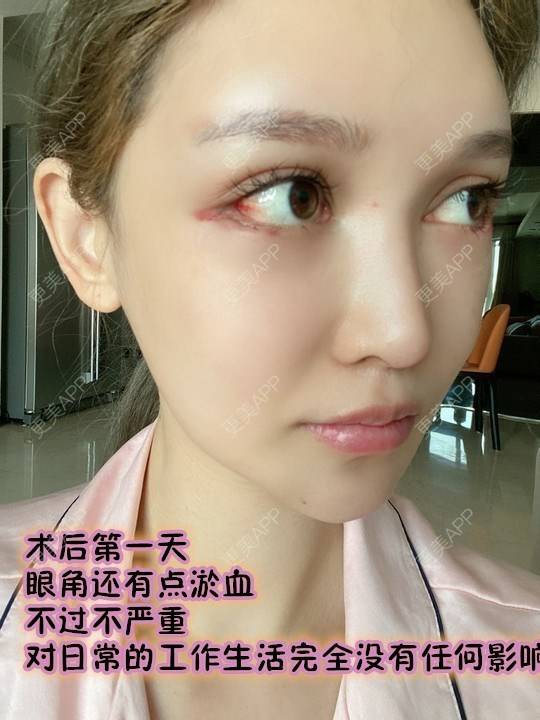 眼睑下至前后对比照_abby吴晓辰眼睑下至前后对比照_术后38天__更美