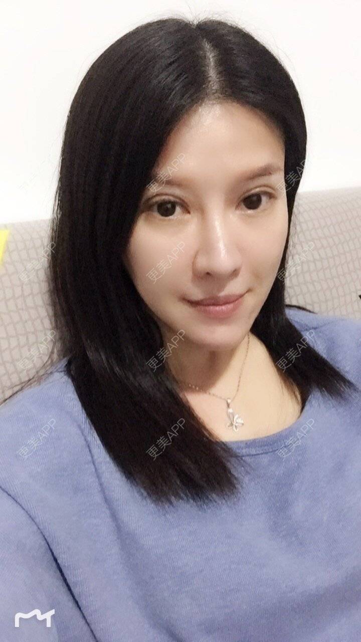 更美 - 甘思佳的热玛吉经验 | 北京 | 热玛吉