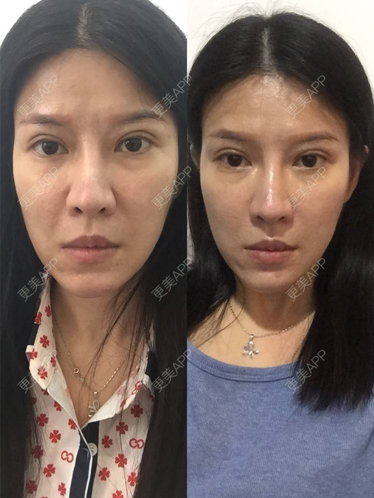 更美 - 甘思佳的热玛吉经验 | 北京 | 热玛吉