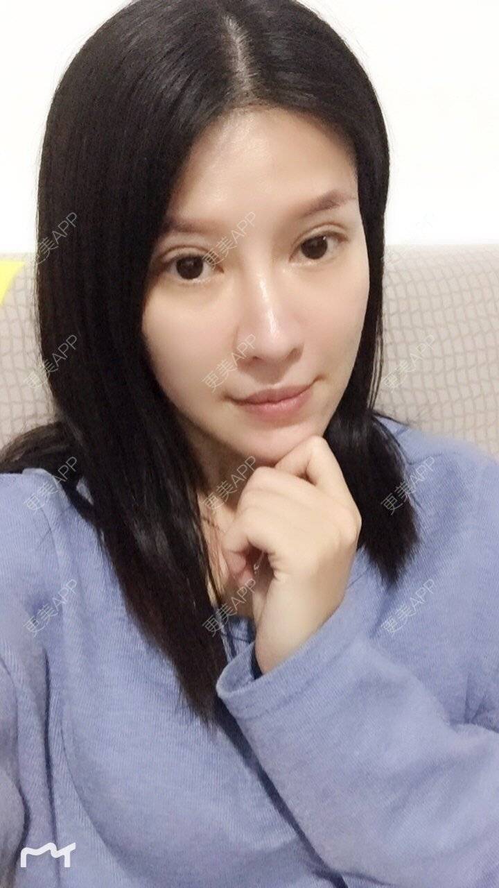 更美 - 甘思佳的热玛吉经验 | 北京 | 热玛吉