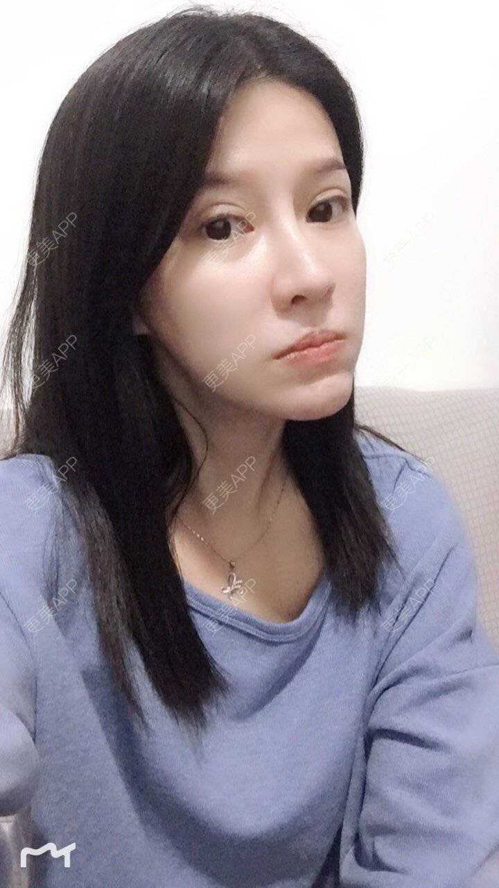更美 - 甘思佳的热玛吉经验 | 北京 | 热玛吉