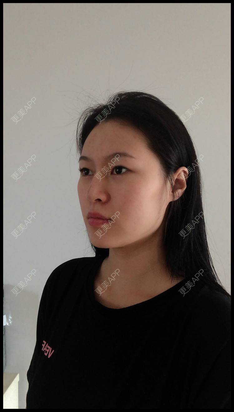 更美 - 作业的葬礼我定盛装出的双眼皮经验 | 双眼皮 | 无锡