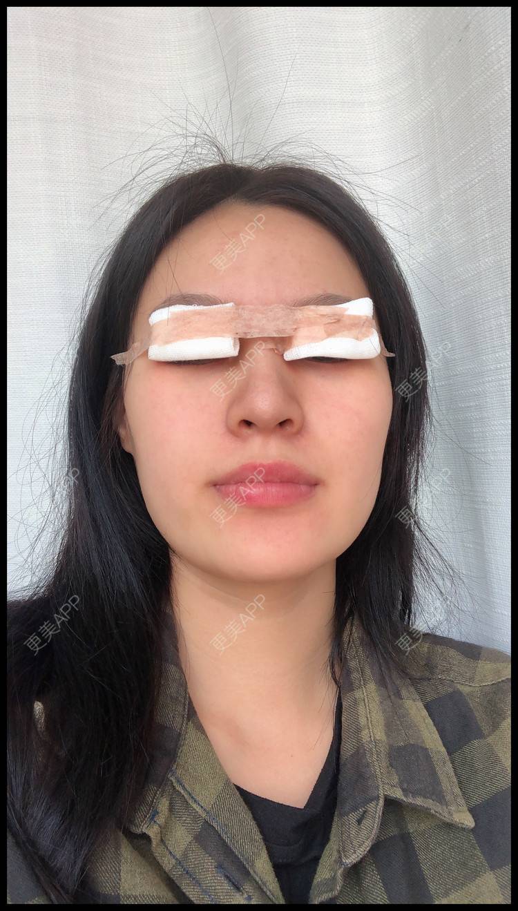 更美 - 作业的葬礼我定盛装出的双眼皮经验 | 双眼皮 | 无锡