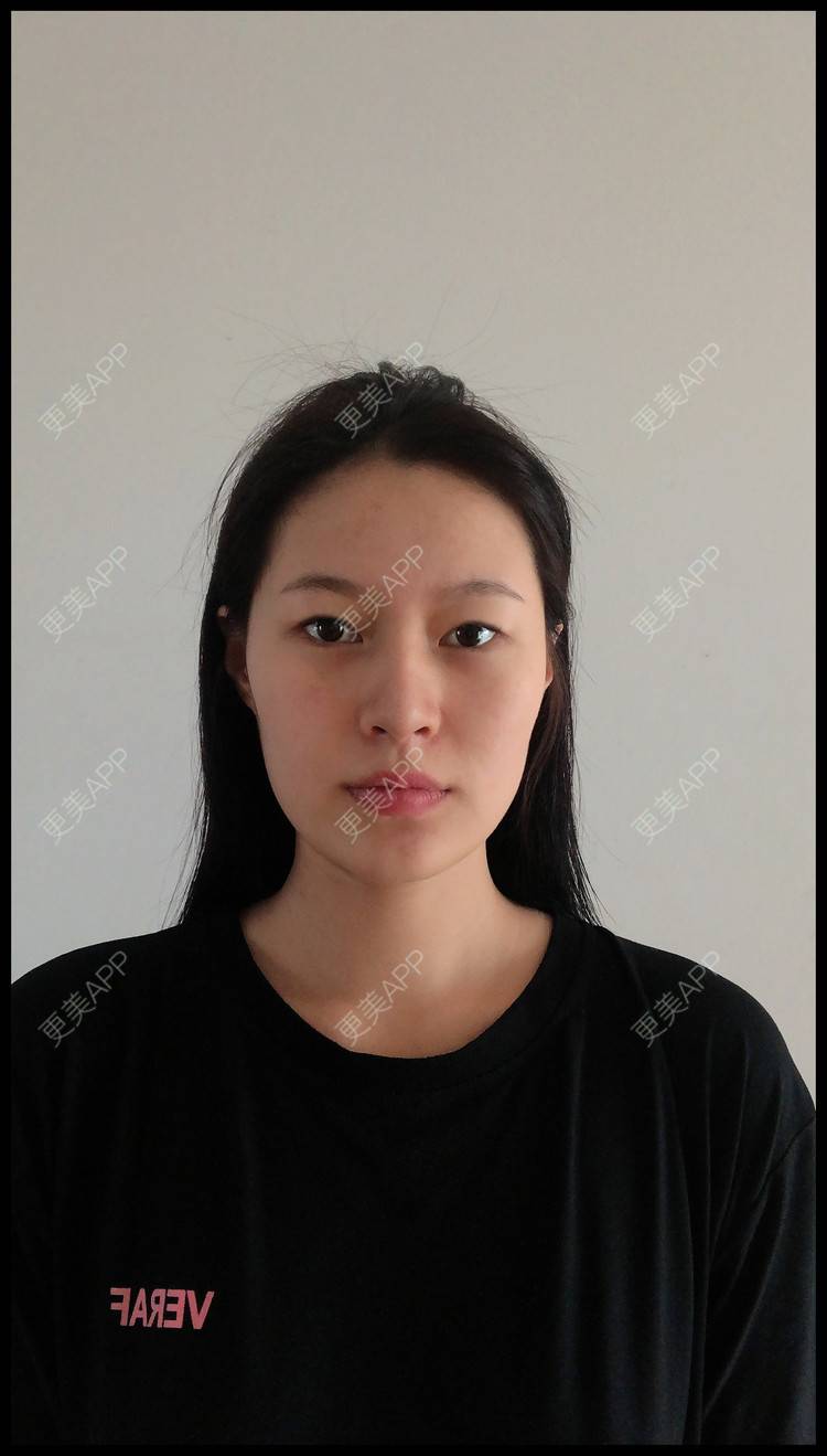 更美 - 作业的葬礼我定盛装出的双眼皮经验 | 双眼皮 | 无锡