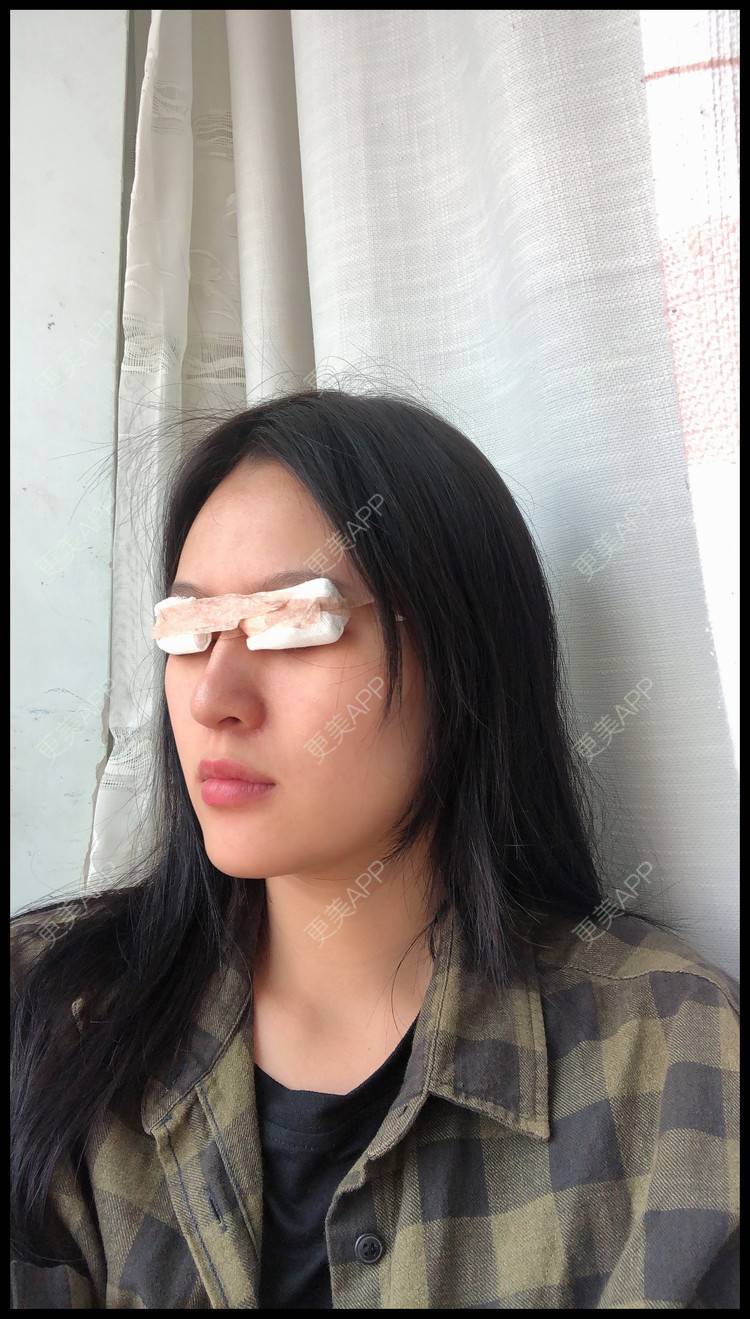 更美 - 作业的葬礼我定盛装出的双眼皮经验 | 双眼皮 | 无锡