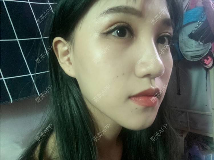 更美 - 更美用户adRwJmFyqQ的除皱瘦脸经验 | 除皱瘦脸 | 深圳