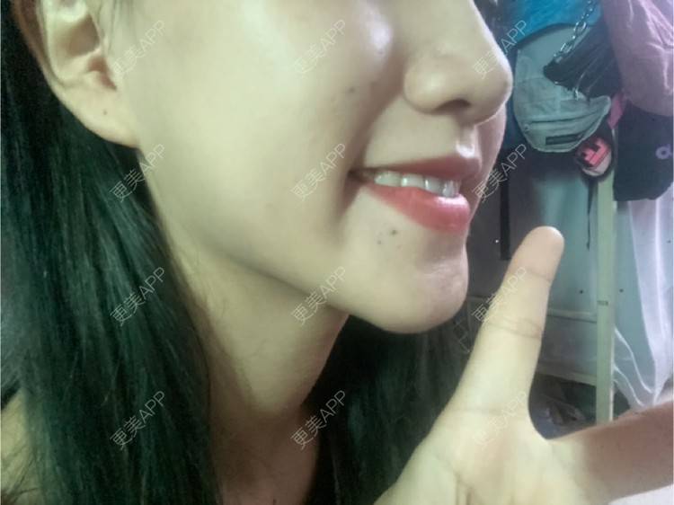 更美 - 更美用户adRwJmFyqQ的除皱瘦脸经验 | 除皱瘦脸 | 深圳