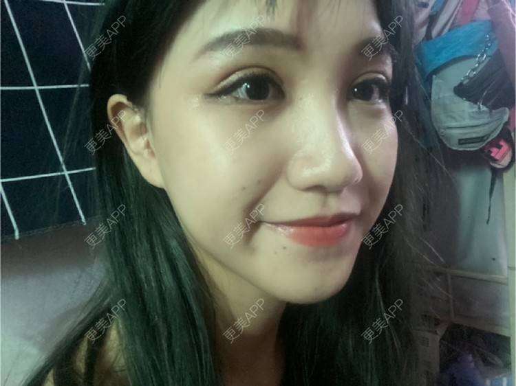 更美 - 更美用户adRwJmFyqQ的除皱瘦脸经验 | 除皱瘦脸 | 深圳