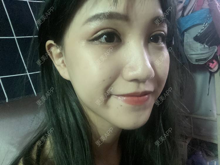 更美 - 更美用户adRwJmFyqQ的除皱瘦脸经验 | 除皱瘦脸 | 深圳