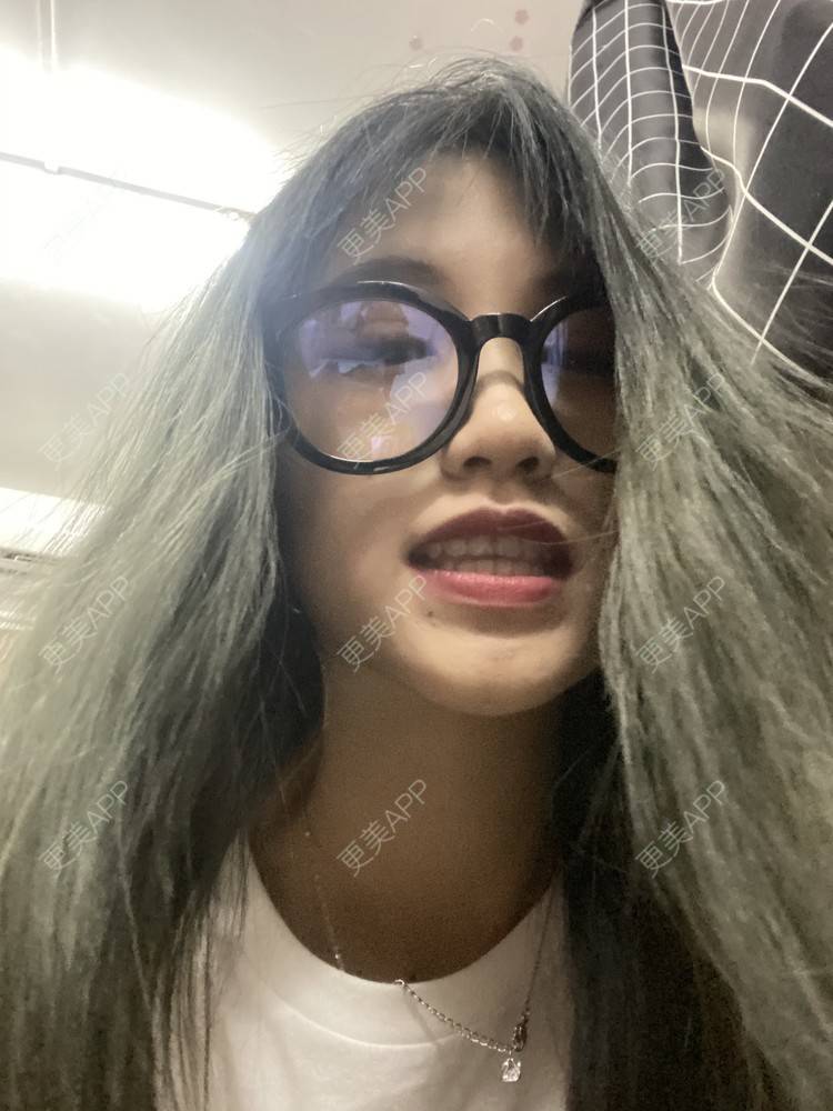 更美 - 更美用户adRwJmFyqQ的除皱瘦脸经验 | 除皱瘦脸 | 深圳