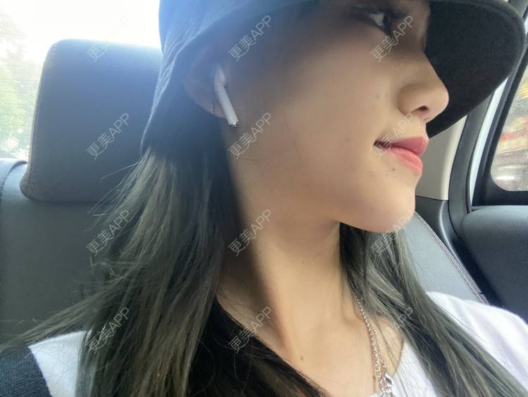 更美 - 更美用户adRwJmFyqQ的除皱瘦脸经验 | 除皱瘦脸 | 深圳