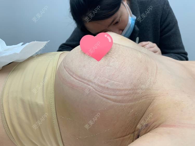 更美 - 爱美果冻的隆胸手术修复经验 | 隆胸手术修复