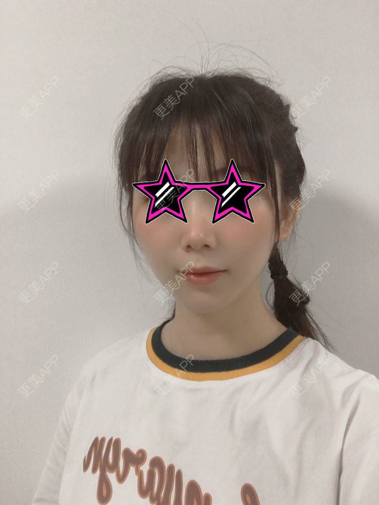 更美 - 更美用户YDAOibjyBB的双下巴吸脂经验 | 双下巴吸脂