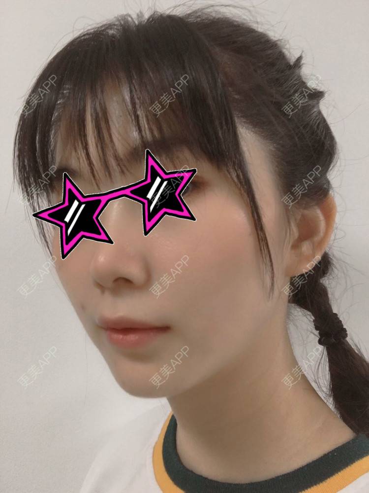 更美 - 更美用户YDAOibjyBB的双下巴吸脂经验 | 双下巴吸脂