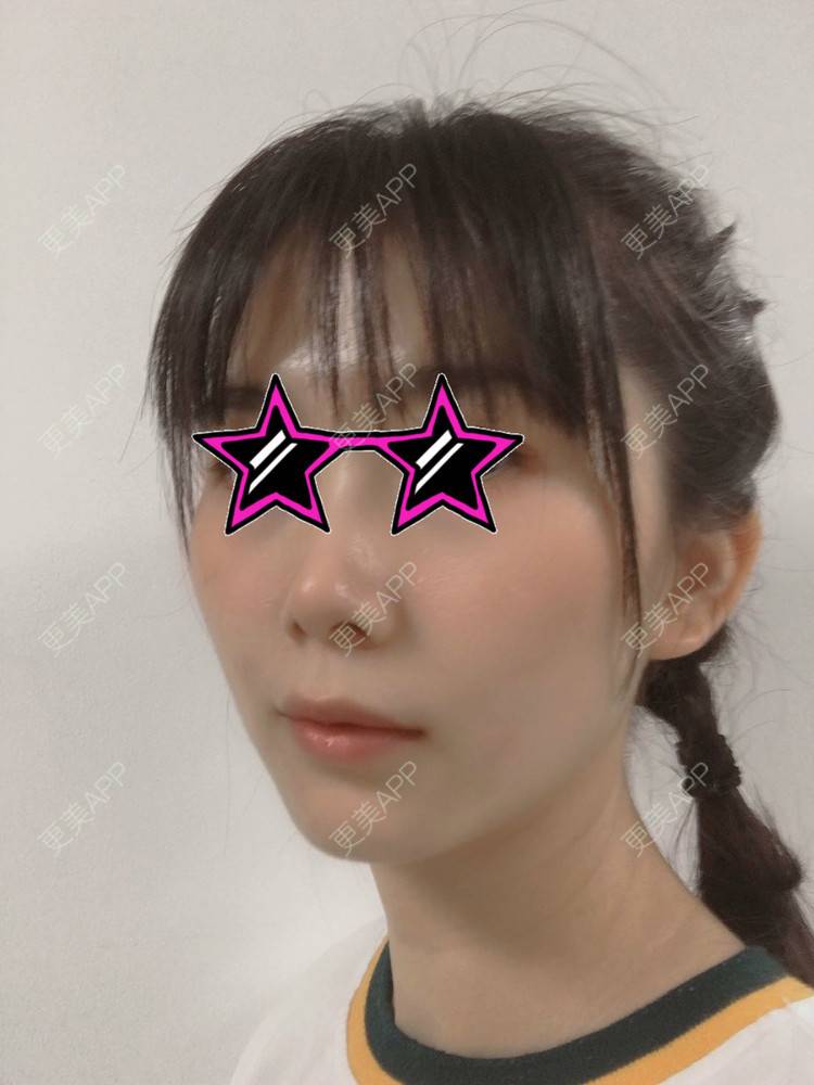 更美 - 更美用户YDAOibjyBB的双下巴吸脂经验 | 双下巴吸脂
