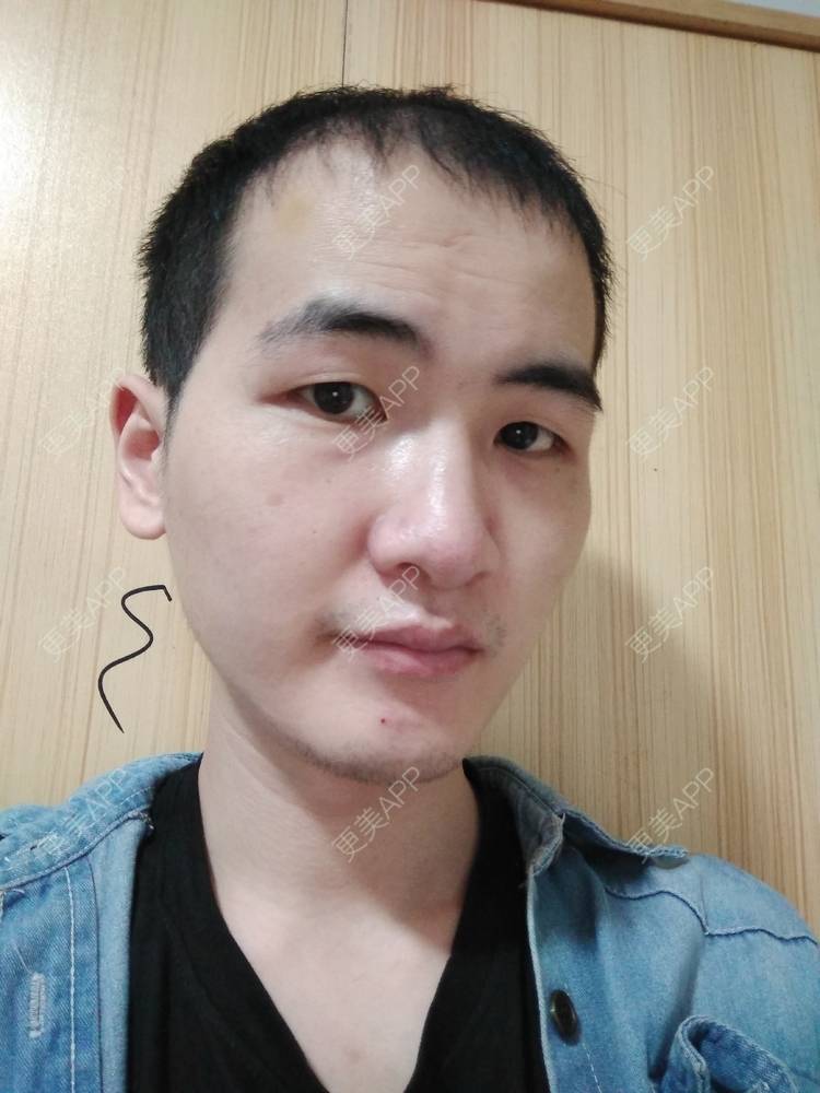 更美 - 更美用户wHSFRCieMm的植胡须经验 | 武汉 | 植胡须