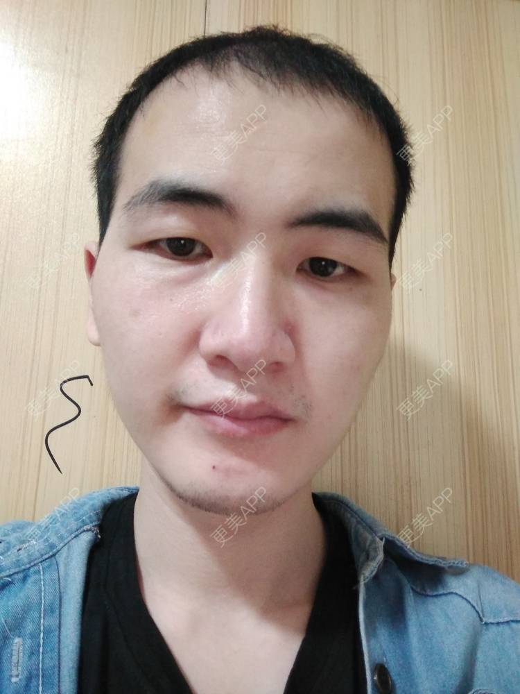 更美 - 更美用户wHSFRCieMm的植胡须经验 | 武汉 | 植胡须