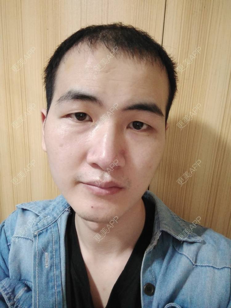 更美 - 更美用户wHSFRCieMm的植胡须经验 | 武汉 | 植胡须