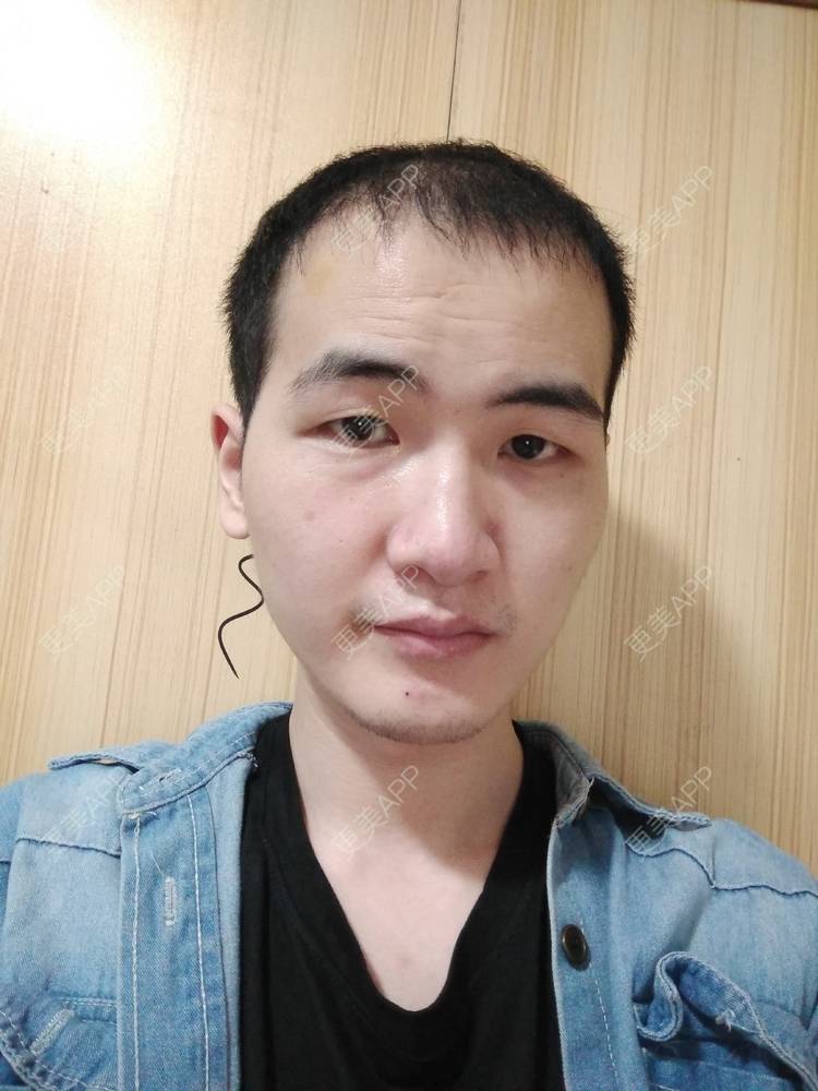 更美 - 更美用户wHSFRCieMm的植胡须经验 | 武汉 | 植胡须
