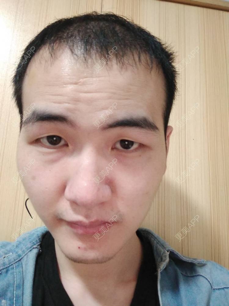更美 - 更美用户wHSFRCieMm的植胡须经验 | 武汉 | 植胡须