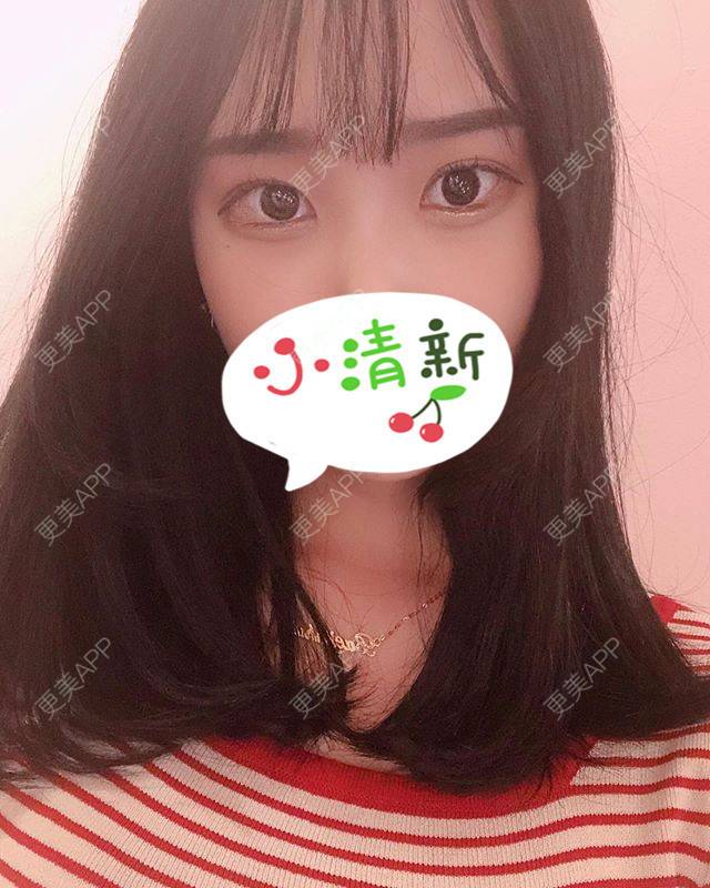 更美 - 更美用户jWOw0G7xxJ的自体脂肪丰卧蚕经验 | 自体脂肪丰卧蚕 | 上海