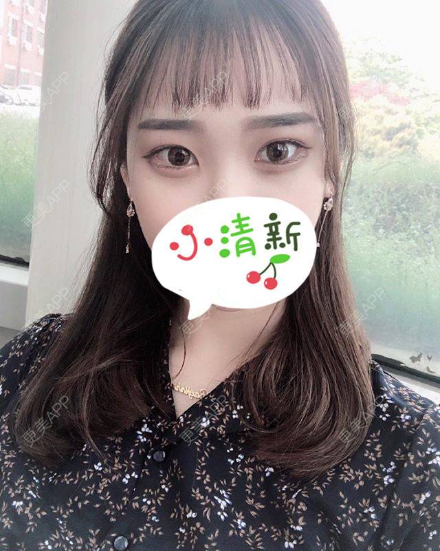 更美 - 更美用户jWOw0G7xxJ的自体脂肪丰卧蚕经验 | 自体脂肪丰卧蚕 | 上海
