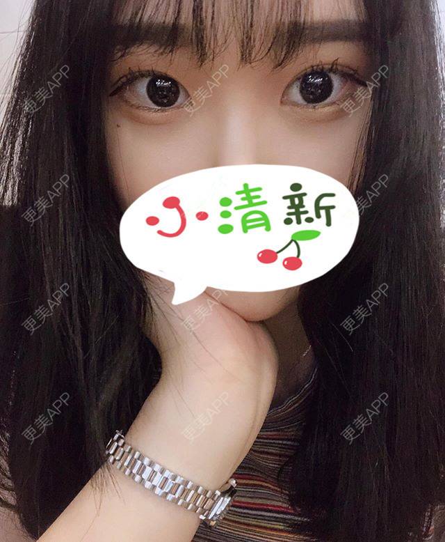 更美 - 更美用户jWOw0G7xxJ的自体脂肪丰卧蚕经验 | 自体脂肪丰卧蚕 | 上海