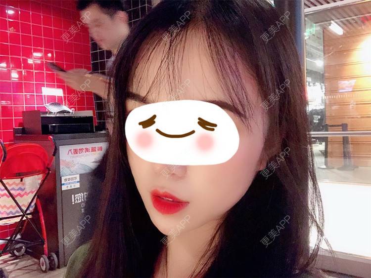 更美 - 更美用户giwbaHYoBg的M唇成形经验 | M唇成形
