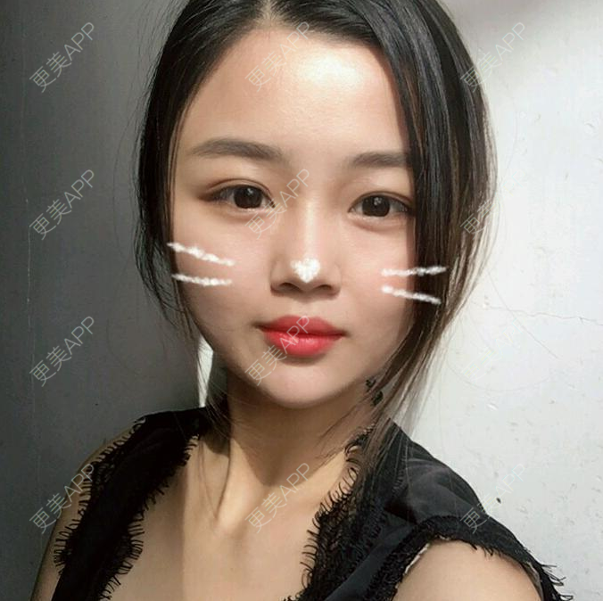 更美 - 巷末缘的自体脂肪填充泪沟经验 | 自体脂肪填充泪沟 | 自体脂肪全面部填充 | 自体脂肪丰面颊 | 北京 | 自体脂肪丰苹果肌