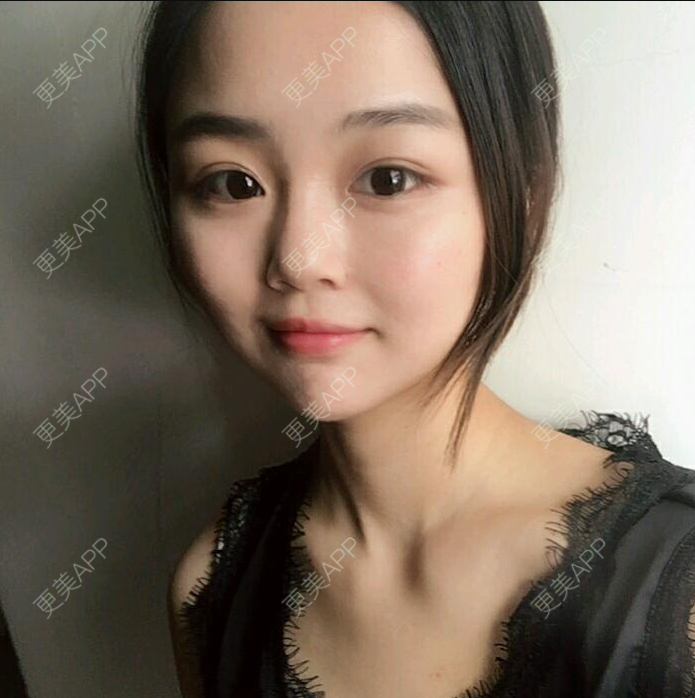 更美 - 巷末缘的自体脂肪填充泪沟经验 | 自体脂肪填充泪沟 | 自体脂肪全面部填充 | 自体脂肪丰面颊 | 北京 | 自体脂肪丰苹果肌